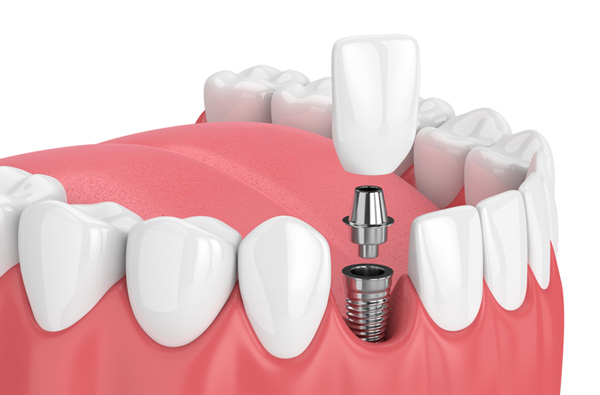 DENTAL  İMPLANTLAR